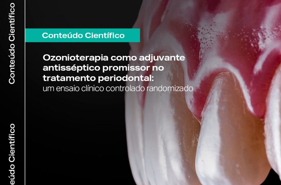 Ozonioterapia como adjuvante antisséptico promissor do tratamento periodontal 