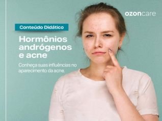 Você sabia que os hormônios andrógenos podem influenciar no aparecimento da acne?